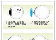 国货自强 明月轻松控临床试验成果在国际顶尖眼科期刊发表