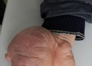 阿里健康拿下贝捷迈®全国首发 系中国首个腱鞘巨细胞瘤（TGCT）口服新药