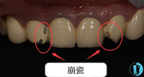全瓷牙行业市场深度调研与供需评估、发展现状与市场竞争格局分析_人保服务,人保有温度