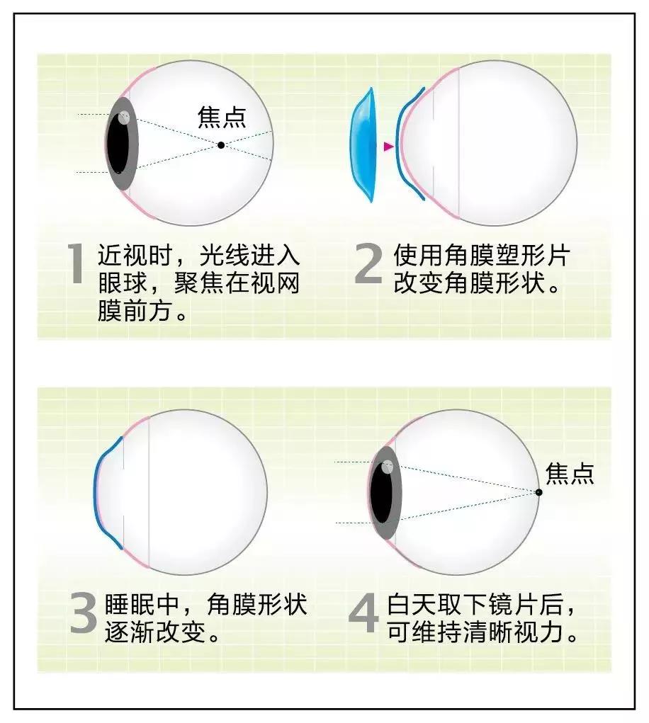 国货自强 明月轻松控临床试验成果在国际顶尖眼科期刊发表