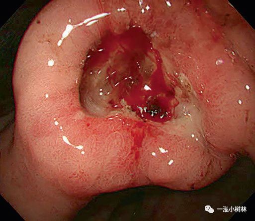 泰恩康CKBA乳膏玫瑰痤疮临床再提速:IIa期数据亮眼,IIb期提前启动